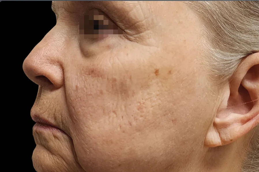 Cheek and lines around the eye after treatment