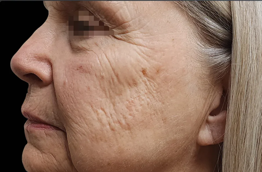 Cheek and lines around the eye before treatment