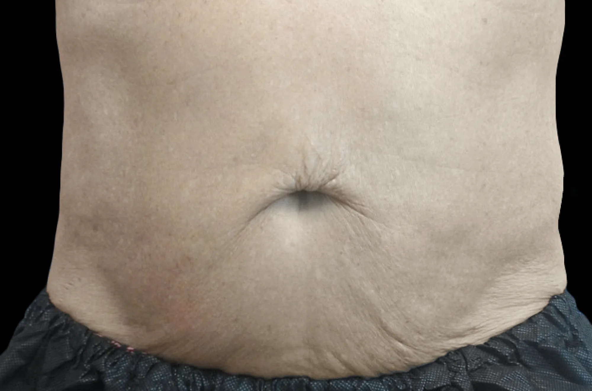 Abdomen after treatment