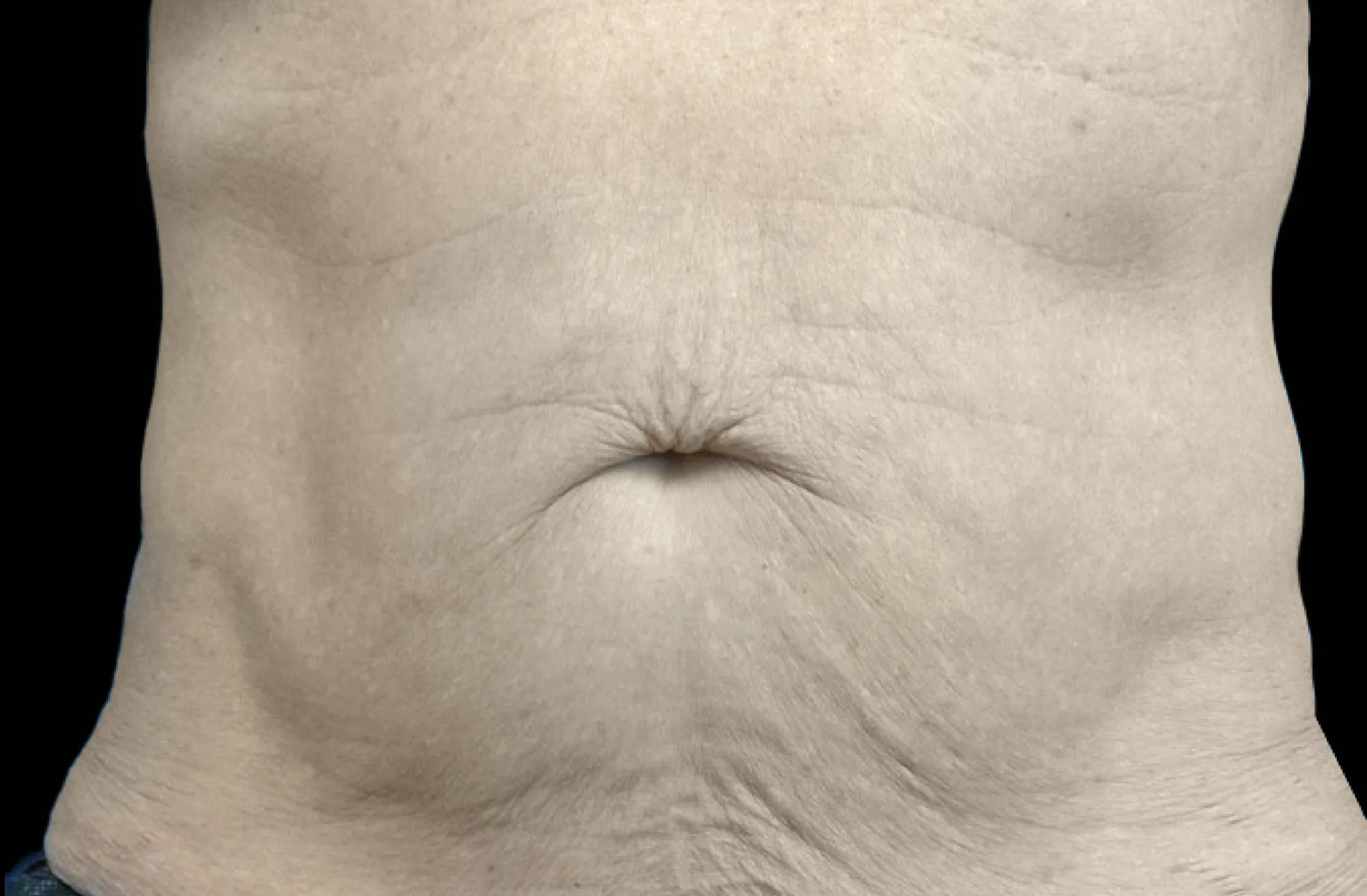 Abdomen before treatment