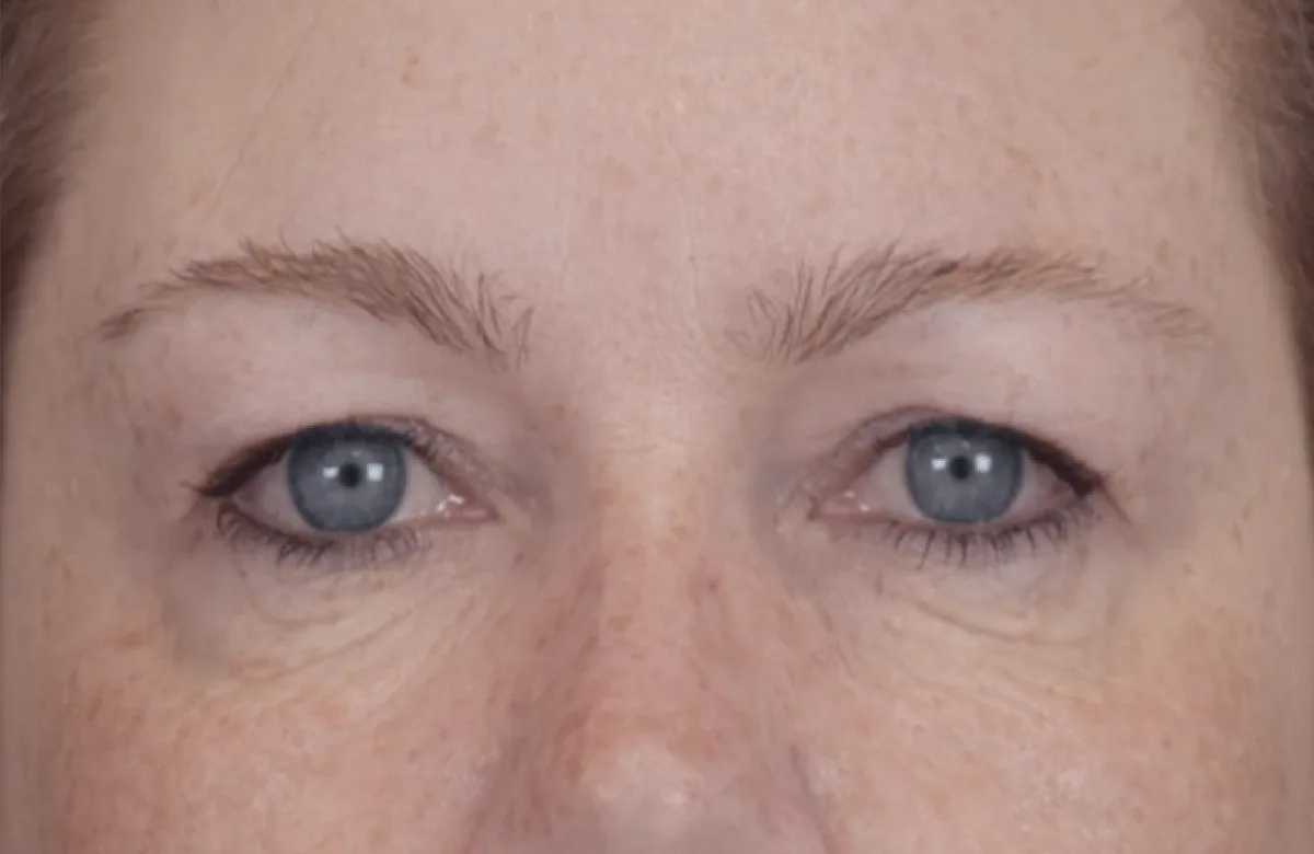 Under-eye after treatment