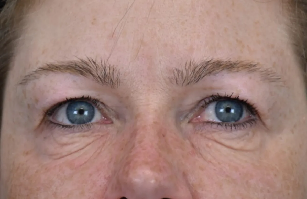 Under-eye before treatment