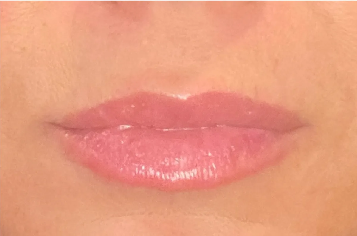 Lips after treatment