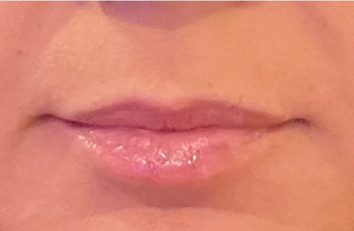 Lips before treatment