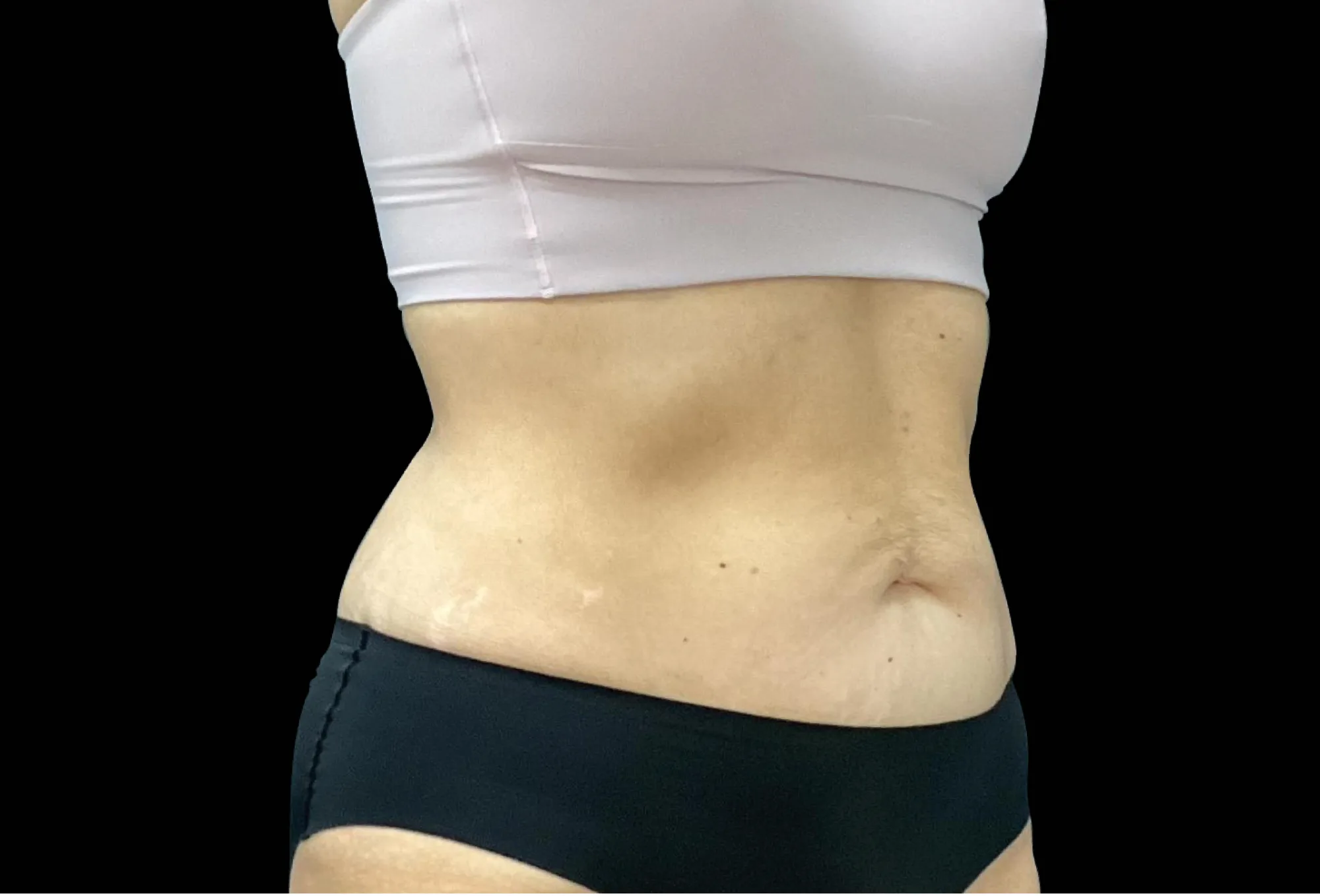Abdomen with weight loss after treatment