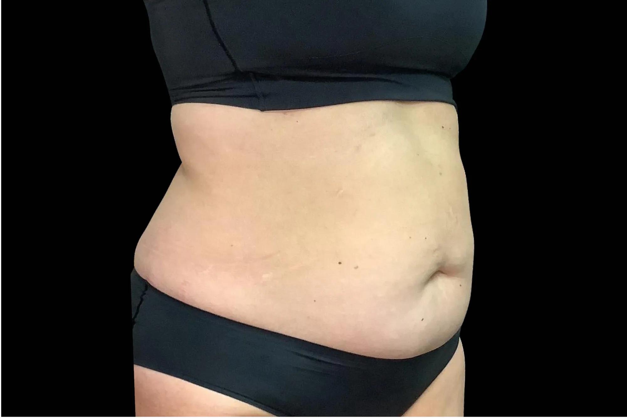 Abdomen with weight loss before treatment