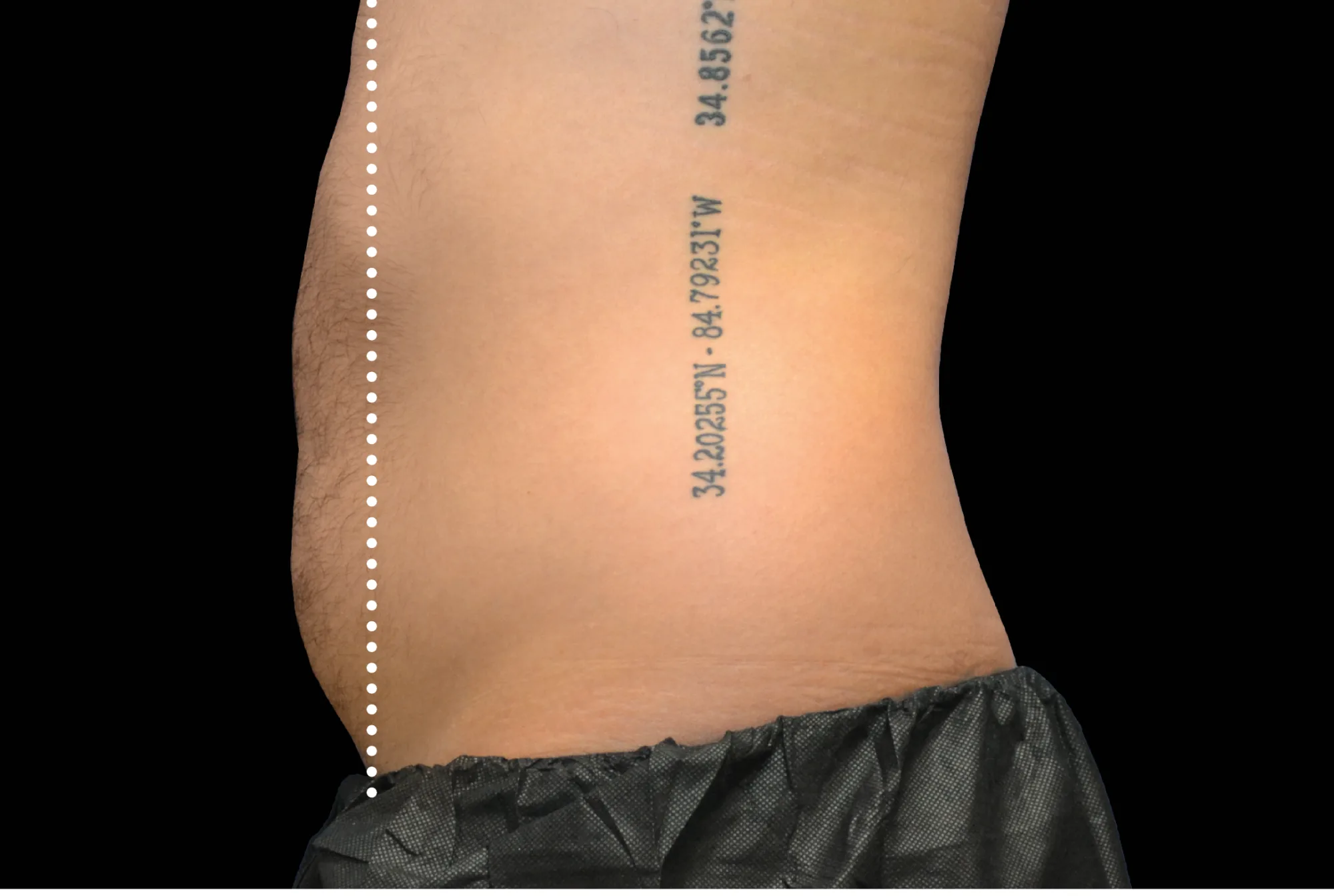 Abdomen after treatment