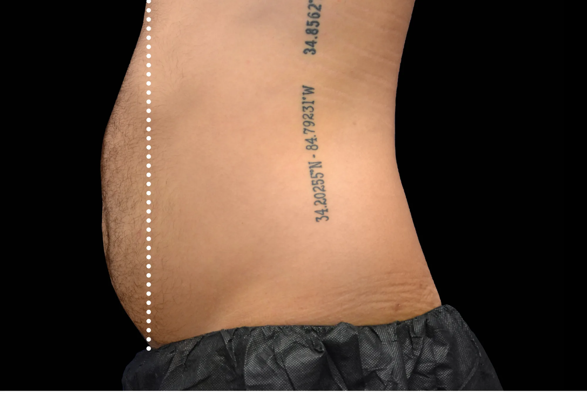 Abdomen before treatment