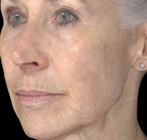 Pigment correction after treatment