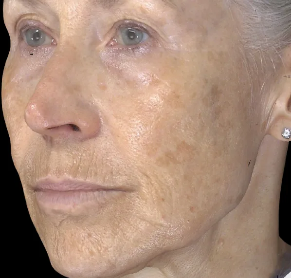 Pigment correction before treatment