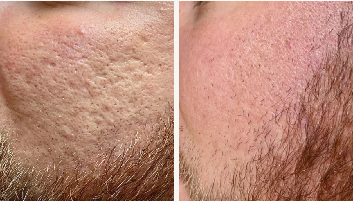 Acne scarring before and after treatment